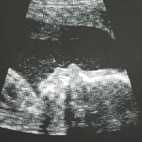 Beim gestrigen Organscreening