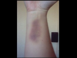 Ihhhh ..... Arm!.jpg