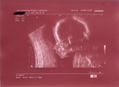 Knödel  SSW 21+4.JPG