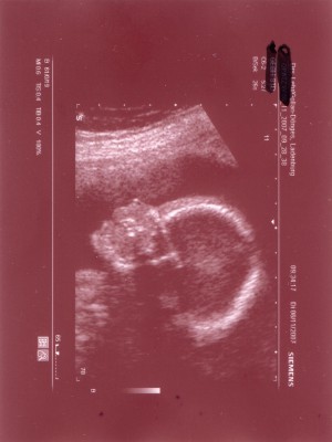 Knödel1  SSW 21+4.JPG