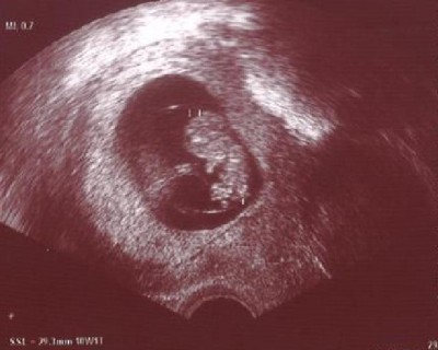 Baby 9+4 kl.JPG