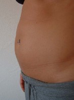 Puregon-Bauch, 8. Stimu-Tag