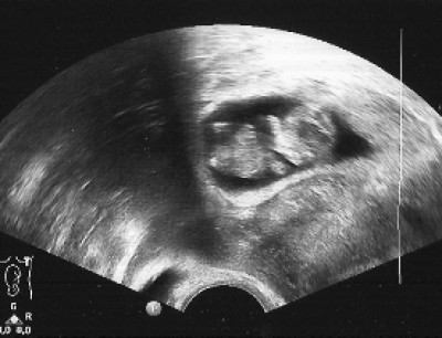 hier unser Bauchzwerg :) bei 10+2
